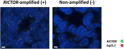 mTOR hyperactivity and RICTOR amplification as targets for personalized treatments in malignancies